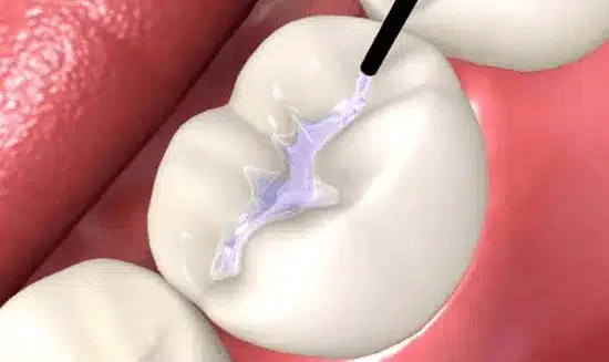 pediatric dentist applying sealant on kids molars