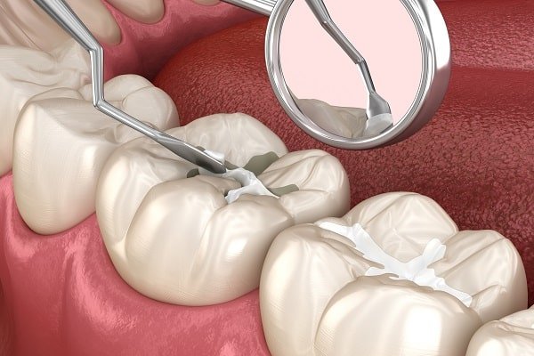 child receiving dental sealants treatment in Midvale UT